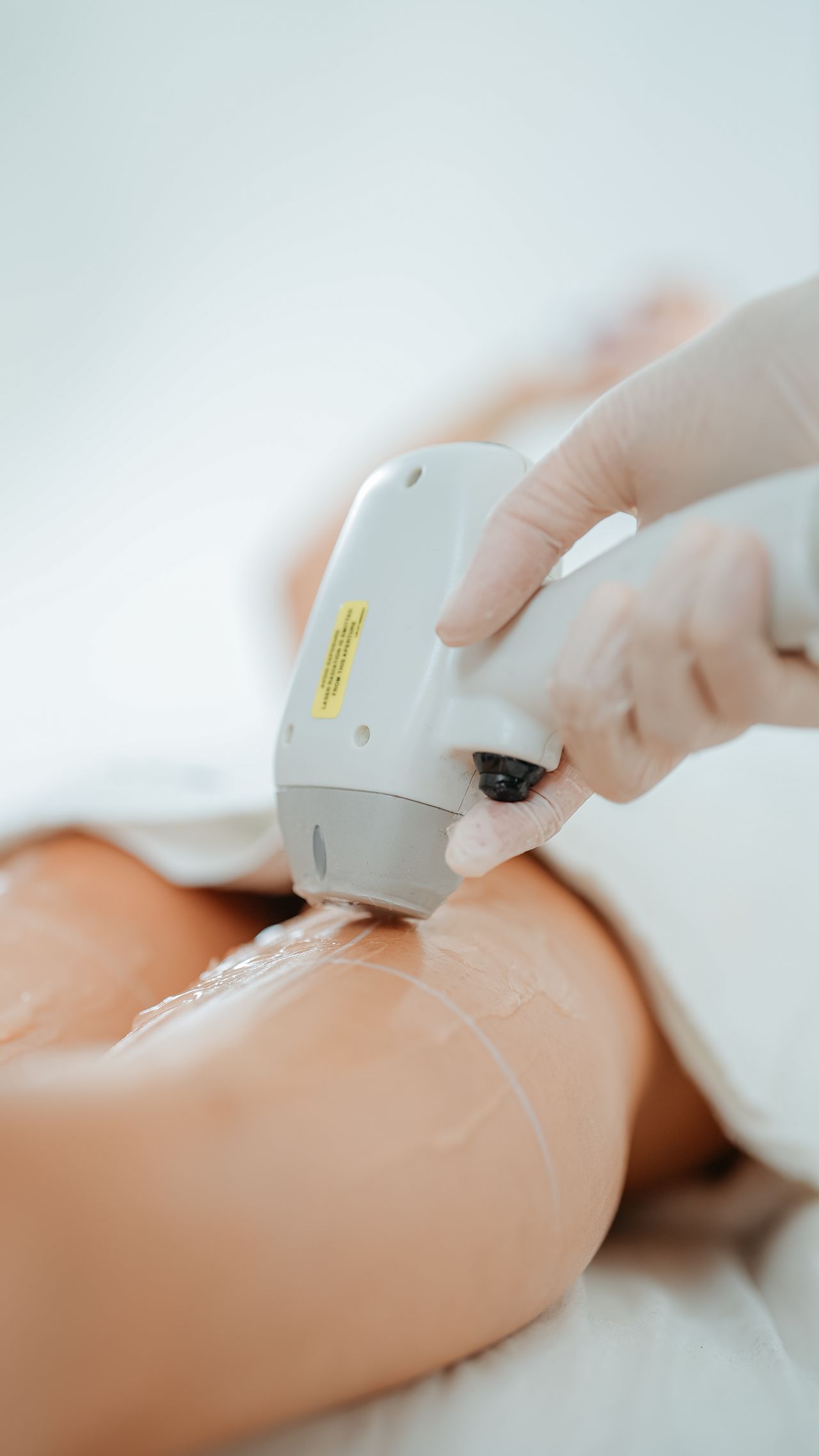 Lady getting laser hair removal treatment Lush BeautynSpa